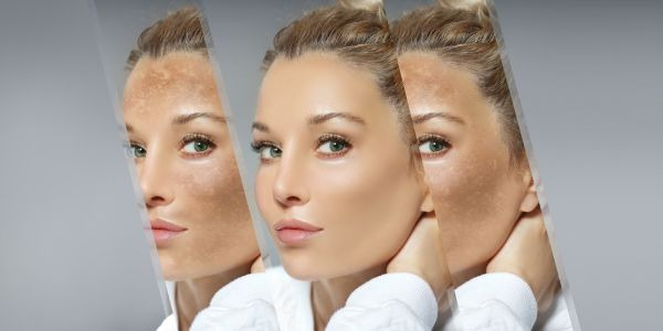 Taches Brunes : Solutions pour un teint parfait